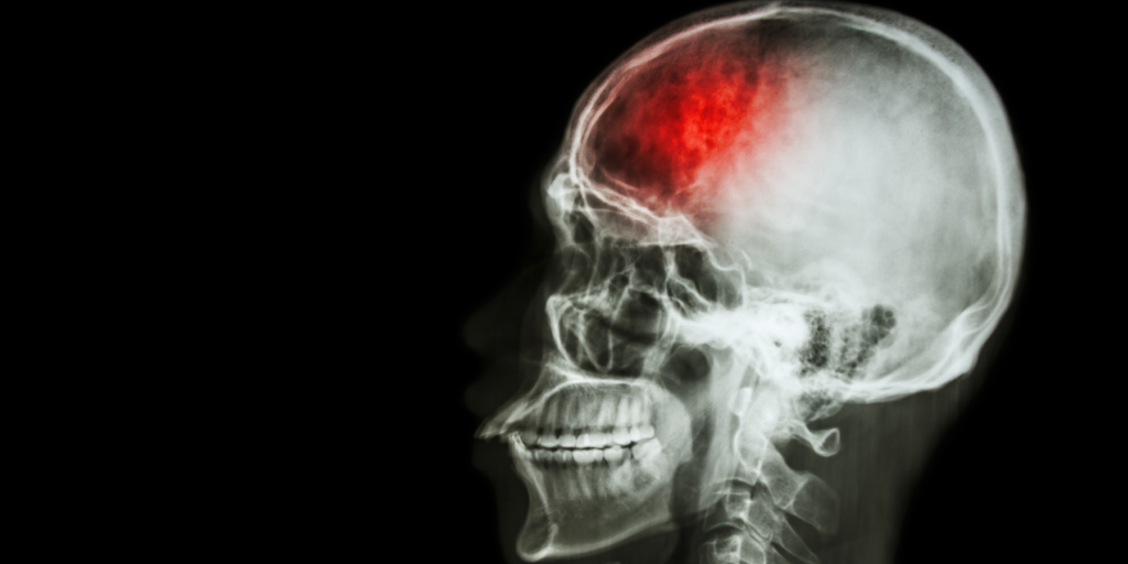 Accidente Cerebrovascular