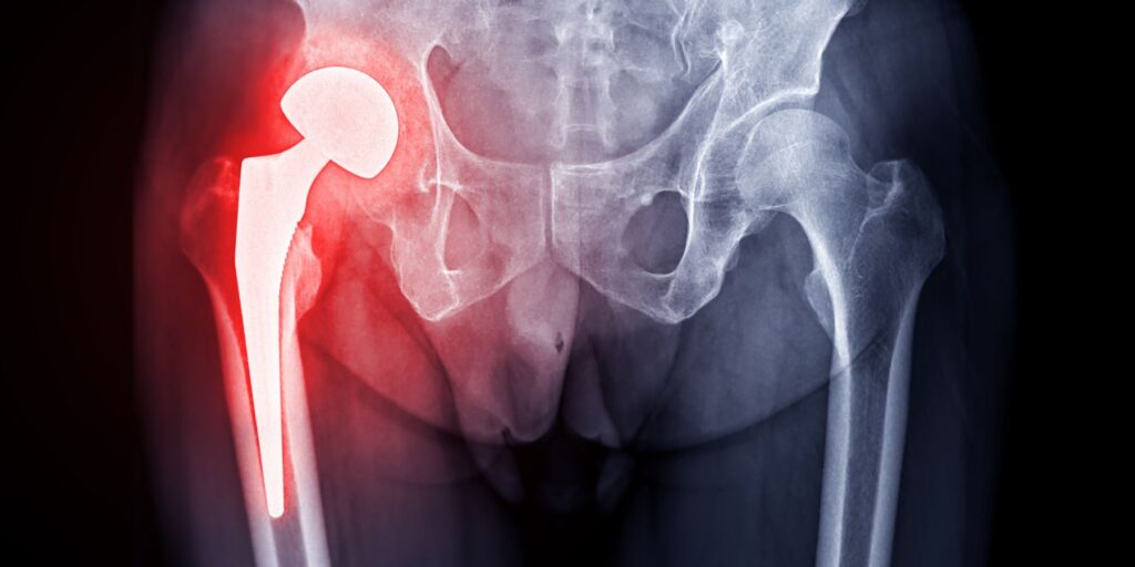reducir inflamación prótesis