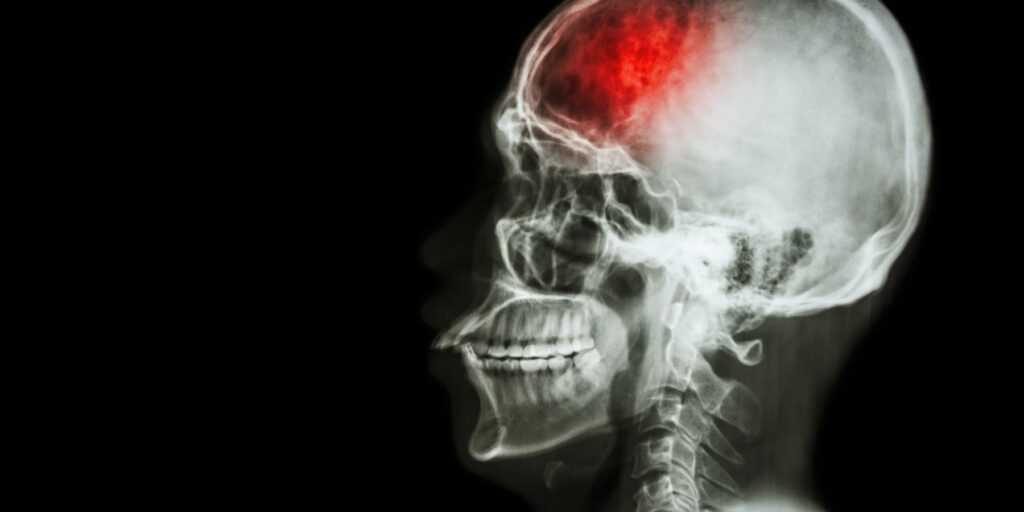 Rehabilitación después de un ACV