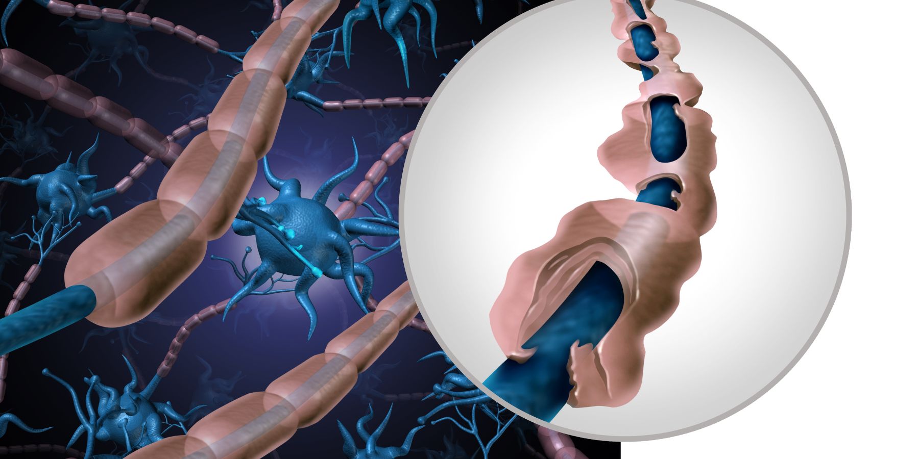 esclerosis múltiple